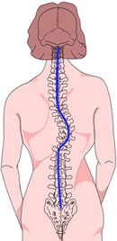 Scoliosis