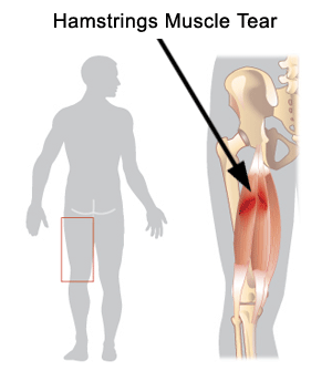 Hamstrings Strain