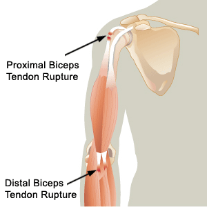 distal bicep tendon