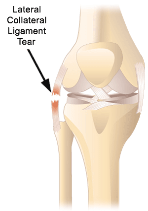 Lateral Collateral Ligament (LCL) Tears
