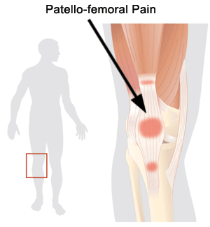 Anterior Knee Pain