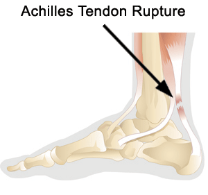 Achilles Tendon Rupture