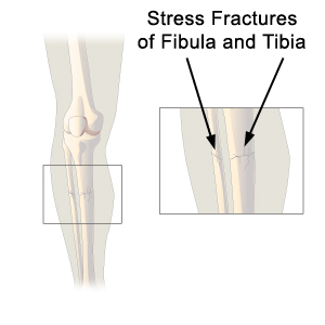 Stress Fractures