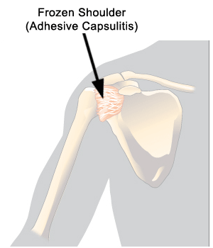 Adhesive Capsulitis - Frozen Shoulder