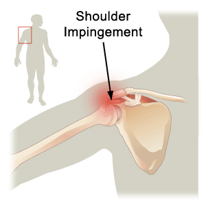 Shoulder Tgendonitis and Impingement