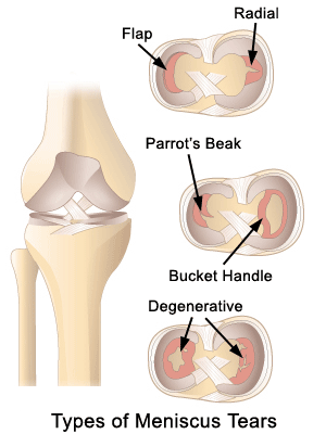 Meniscal Tears