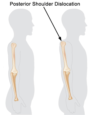 Posterior Dislocation