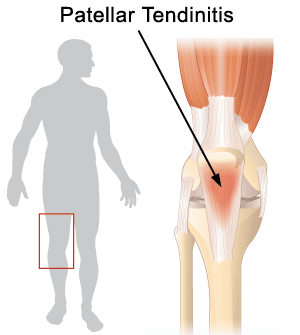 Anterior Patella