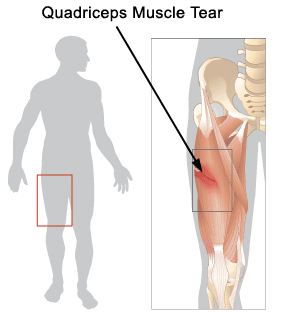 Quadriceps Muscle Strains