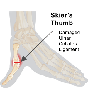 Skiers Thumb