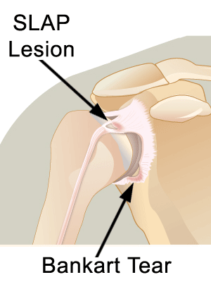 Tear Labrum Hip Symptoms