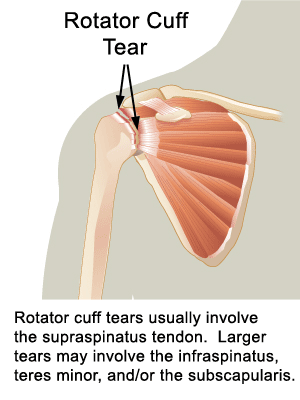 Rotator Cuff Tears